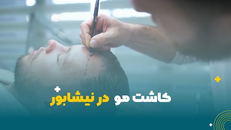 کاشت مو در نیشابور