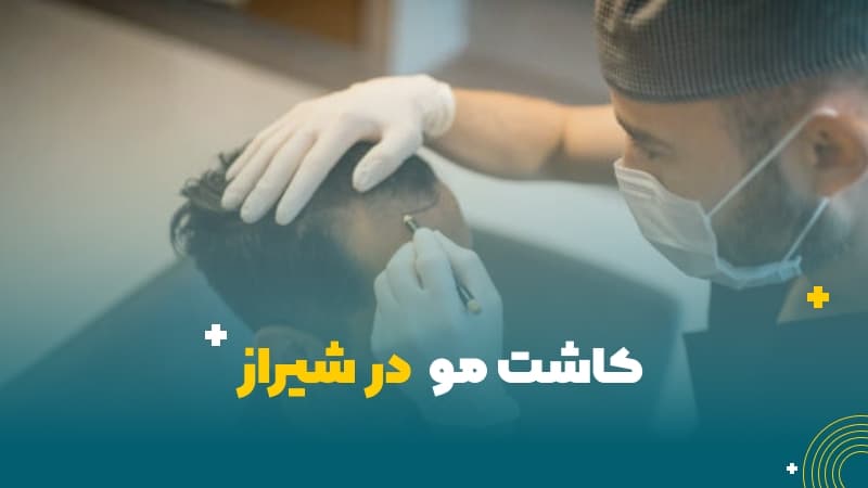 کاشت مو در شیراز