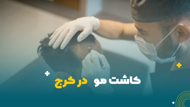 کاشت مو در کرج