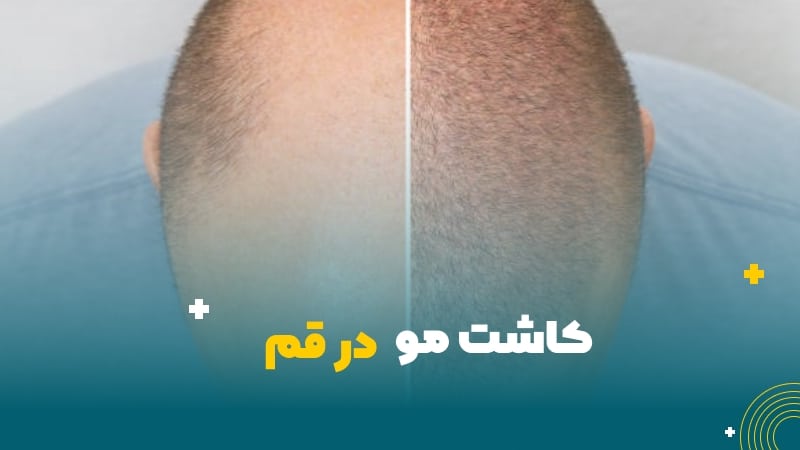 کاشت مو در قم
