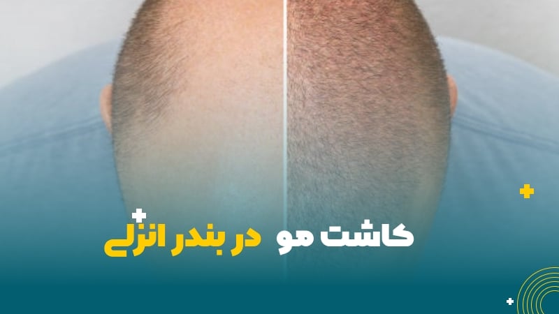 کاشت مو در بندر انزلی