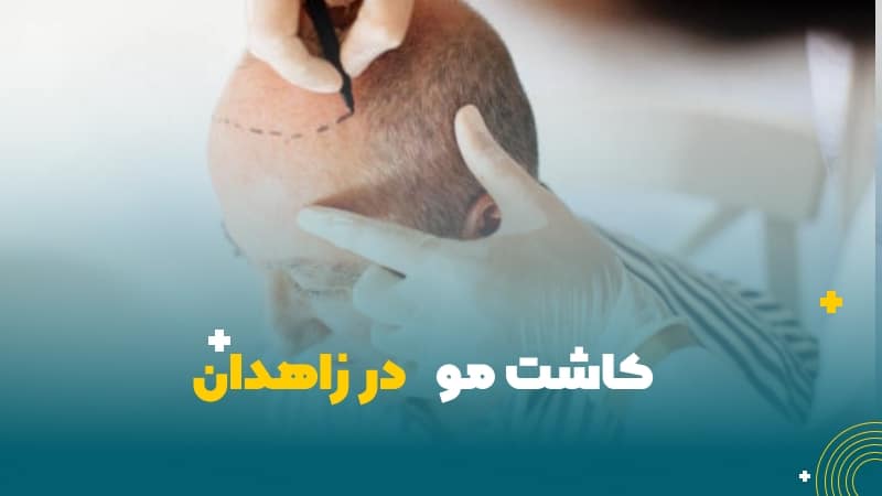 کاشت مو در زاهدان