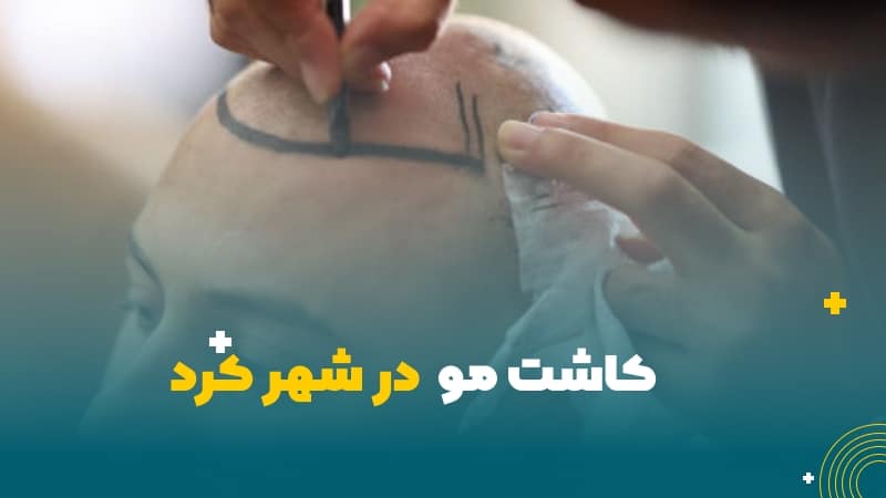 کاشت مو در شهرکرد