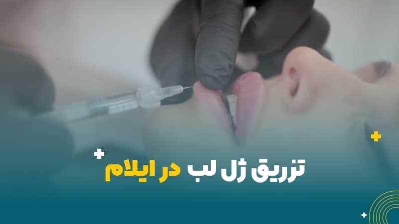 تزریق ژل لب در ایلام