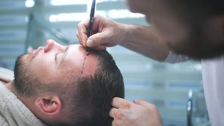 کاشت مو در شیراز