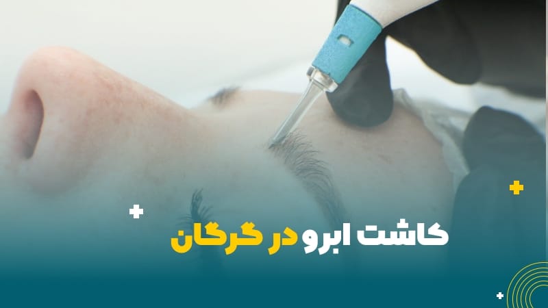 کاشت ابرو در گرگان