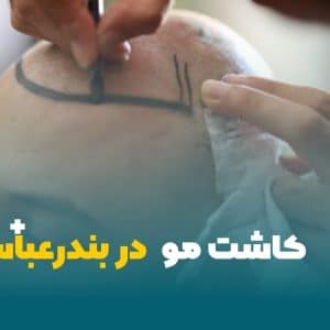 کاشت مو در بندرعباس