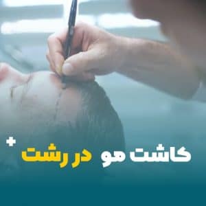 کاشت مو در رشت