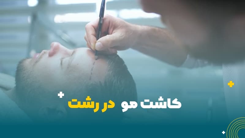 کاشت مو در رشت