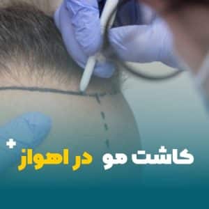 کاشت مو در اهواز