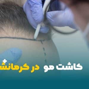 کاشت مو در کرمانشاه