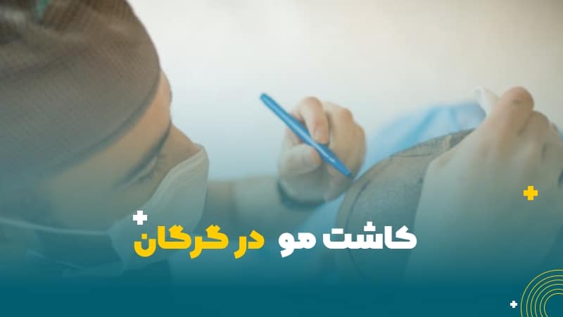کاشت مو در گرگان