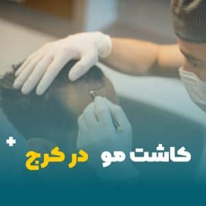 کاشت مو در کرج