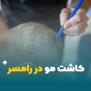 کاشت مو در رامسر