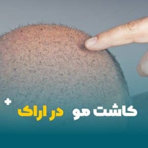 کاشت مو در اراک