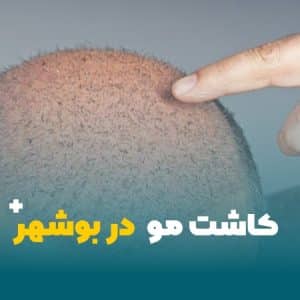 کاشت مو در بوشهر