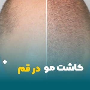 کاشت مو در قم