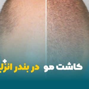 کاشت مو در بندر انزلی