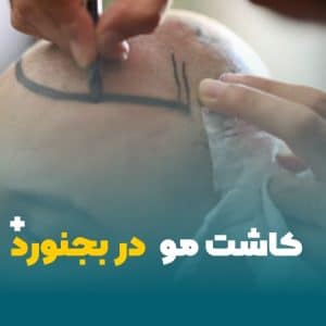 کاشت مو در بجنورد