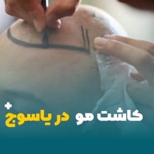 کاشت مو در یاسوج