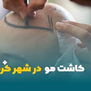 کاشت مو در شهرکرد