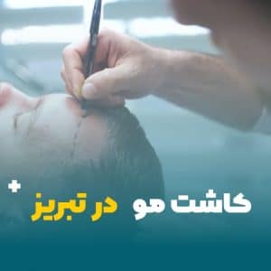 کاشت مو در تبریز