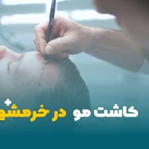 کاشت مو در خرمشهر