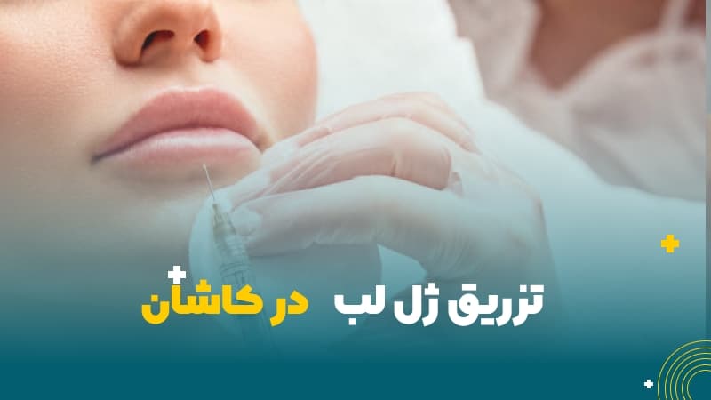 تزریق ژل لب در کاشان